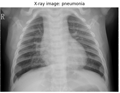 Chest X-Ray Pneumonia Classification