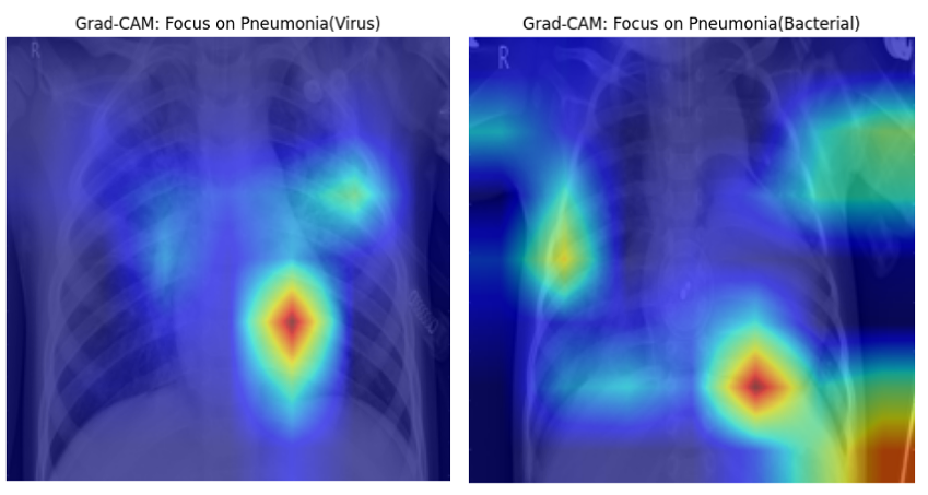 Grad-CAM for Pneumonia X-ray